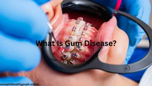 What Is Gum Disease